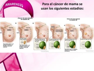 Para el cáncer de mama se
usan los siguientes estadios:
 