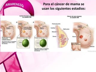Para el cáncer de mama se
usan los siguientes estadios:
 