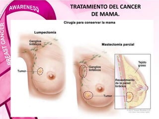 TRATAMIENTO DEL CANCER
DE MAMA.
 