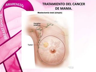 TRATAMIENTO DEL CANCER
DE MAMA.
 
