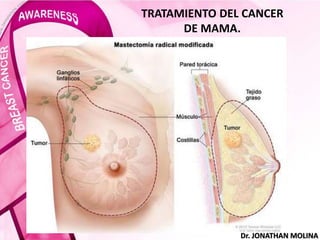 TRATAMIENTO DEL CANCER
DE MAMA.
Dr. JONATHAN MOLINA
 