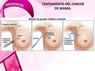 TRATAMIENTO DEL CANCER
DE MAMA.
 