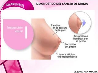 DIAGNOSTICO DEL CÁNCER DE MAMA
Dr. JONATHAN MOLINA
 