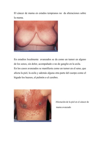 El cáncer de mama en estados tempranos no da alteraciones sobre
la mama.




En estadios localmente avanzados se da como un tumor en alguno
de los senos, sin dolor, acompañado o no de ganglio en la axila.
En los casos avanzados se manifiesta como un tumor en el seno, que
afecta la piel, la axila y además alguna otra parte del cuerpo como el
hígado los huesos, el pulmón o el cerebro.




                                        Afectación de la piel en el cáncer de

                                        mama avanzado
 