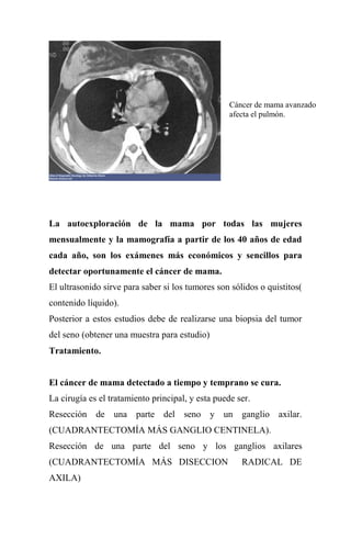 Cáncer de mama avanzado
                                                   afecta el pulmón.




La autoexploración de la mama por todas las mujeres
mensualmente y la mamografía a partir de los 40 años de edad
cada año, son los exámenes más económicos y sencillos para
detectar oportunamente el cáncer de mama.
El ultrasonido sirve para saber si los tumores son sólidos o quistitos(
contenido líquido).
Posterior a estos estudios debe de realizarse una biopsia del tumor
del seno (obtener una muestra para estudio)
Tratamiento.


El cáncer de mama detectado a tiempo y temprano se cura.
La cirugía es el tratamiento principal, y esta puede ser.
Resección de una parte del seno y un ganglio axilar.
(CUADRANTECTOMÍA MÁS GANGLIO CENTINELA).
Resección de una parte del seno y los ganglios axilares
(CUADRANTECTOMÍA MÁS DISECCION                        RADICAL DE
AXILA)
 