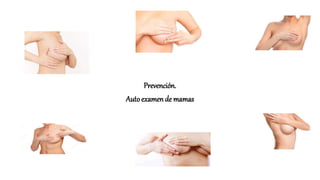 Prevención.
Autoexamende mamas
 