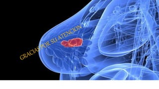 Cancer de mamas  numero 1