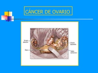 CÁNCER DE OVARIO
 