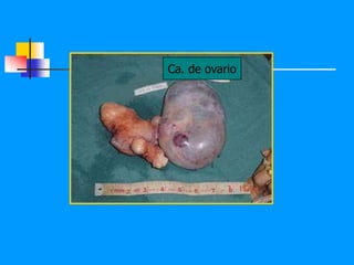 Ca. de ovario
 