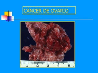 CÁNCER DE OVARIO
 