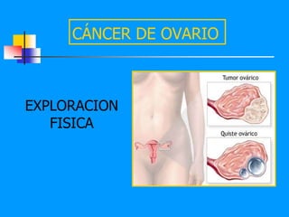 CÁNCER DE OVARIO



EXPLORACION
   FISICA
 