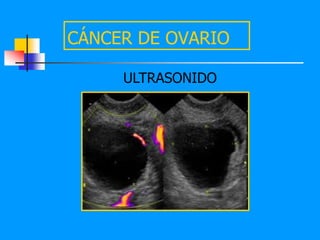 CÁNCER DE OVARIO

     ULTRASONIDO
 