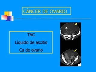 CÁNCER DE OVARIO



      TAC
Líquido de ascitis
  Ca de ovario
 