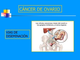 CÁNCER DE OVARIO




VIAS DE
DISEMINACIÓN
 