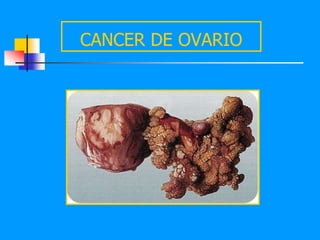 CANCER DE OVARIO
 