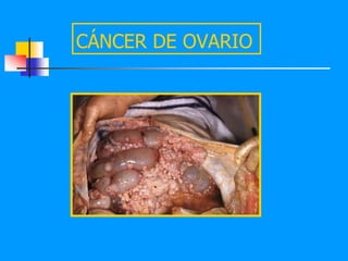 CÁNCER DE OVARIO
 