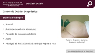 portaldeboaspraticas.iff.fiocruz.br
CÂNCER DE OVÁRIO
Câncer de Ovário: Diagnóstico
• Normal
• Aumento do volume abdominal
• Palpação de massas no abdome
• Ascite
• Palpação de massas anexiais ao toque vaginal e retal
Exame Ginecológico
Tumores do ovário - aumento
do volume abdominal
 