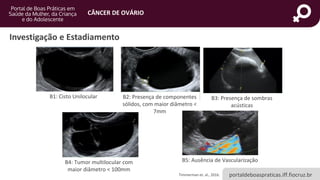 portaldeboaspraticas.iff.fiocruz.br
CÂNCER DE OVÁRIO
Investigação e Estadiamento
Timmerman et. al., 2016.
B1: Cisto Unilocular B2: Presença de componentes
sólidos, com maior diâmetro <
7mm
B3: Presença de sombras
acústicas
B5: Ausência de Vascularização
B4: Tumor multilocular com
maior diâmetro < 100mm
 