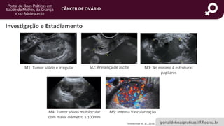 portaldeboaspraticas.iff.fiocruz.br
CÂNCER DE OVÁRIO
Investigação e Estadiamento
Timmerman et. al., 2016.
M1: Tumor sólido e irregular M2: Presença de ascite M3: No mínimo 4 estruturas
papilares
M4: Tumor sólido multilocular
com maior diâmetro ≥ 100mm
M5: Intensa Vascularização
 