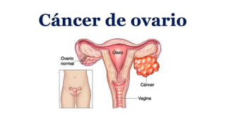 Cáncer de ovario
 