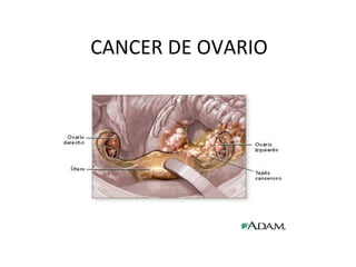 CANCER DE OVARIO 