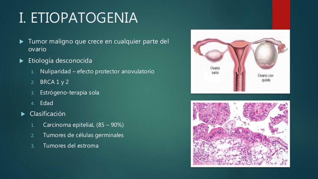 Cancer de ovario Cancer de ovario