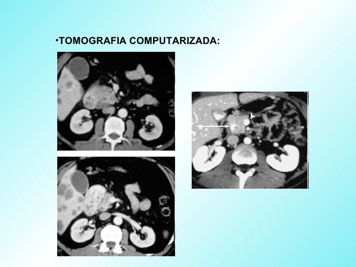 Cancer De Pancreas Cancer De Pancreas