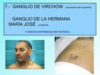 7.- GANGLIO DE VIRCHOW (supraclavicular izquierdo)
GANGLIO DE LA HERMANA
MARÍA JOSÉ (umbilical)
 INDICAN ENFERMEDAD METASTÁSICA
 