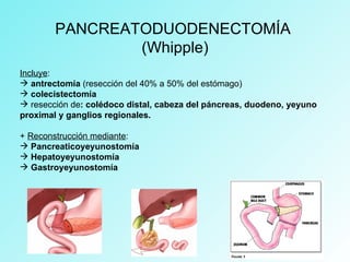 Incluye:
 antrectomía (resección del 40% a 50% del estómago)
 colecistectomía
 resección de: colédoco distal, cabeza del páncreas, duodeno, yeyuno
proximal y ganglios regionales.
+ Reconstrucción mediante:
 Pancreaticoyeyunostomía
 Hepatoyeyunostomía
 Gastroyeyunostomía
PANCREATODUODENECTOMÍA
(Whipple)
 