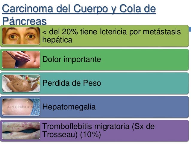 Cancer de pancreas Cancer de pancreas