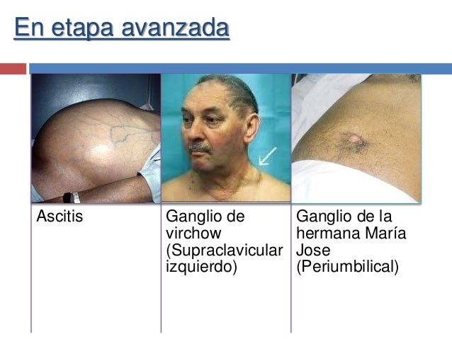 Como varikoz curan por el láser