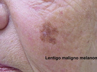 Lentigo maligno melanom
 