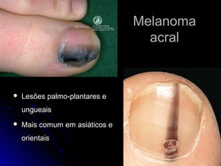 MelanomaMelanoma
acralacral
 Lesões palmo-plantares eLesões palmo-plantares e
ungueaisungueais
 Mais comum em asiáticos eMais comum em asiáticos e
orientaisorientais
 