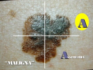 AASSIMETRIASSIMETRIA
AA
““MALIGNA”MALIGNA”
 