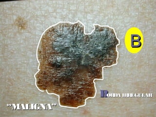 BBORDA IRREGULARORDA IRREGULAR
BB
““MALIGNA”MALIGNA”
 