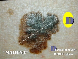 DDIÂMETROMAIORIÂMETROMAIOR
DO QUE 0,6 cmDO QUE 0,6 cm
DD
““MALIGNAMALIGNA””
 