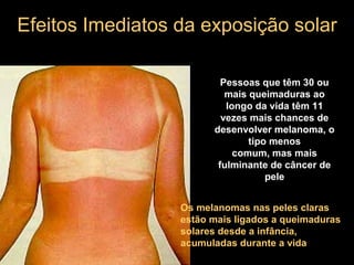 Efeitos Imediatos da exposição solarEfeitos Imediatos da exposição solar
Pessoas que têm 30 ou
mais queimaduras ao
longo da vida têm 11
vezes mais chances de
desenvolver melanoma, o
tipo menos
comum, mas mais
fulminante de câncer de
pele
Os melanomas nas peles claras
estão mais ligados a queimaduras
solares desde a infância,
acumuladas durante a vida
 