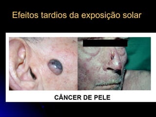 Efeitos tardios da exposição solarEfeitos tardios da exposição solar
 