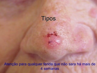 TiposTipos
Atenção para qualquer ferida que não sara há mais de
4 semanas
 