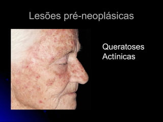 Lesões pré-neoplásicasLesões pré-neoplásicas
Queratoses
Actínicas
 