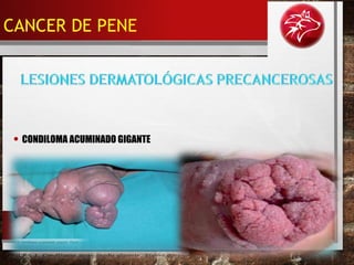 • CONDILOMA ACUMINADO GIGANTE
CANCER DE PENE
 