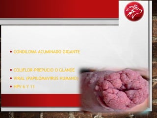 • CONDILOMA ACUMINADO GIGANTE
• COLIFLOR-PREPUCIO O GLANDE
• VIRAL (PAPILOMAVIRUS HUMANO)
• HPV 6 Y 11
 