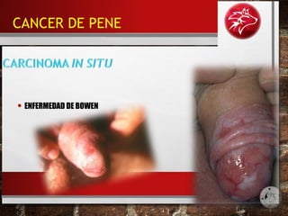 • ENFERMEDAD DE BOWEN
CANCER DE PENE
 