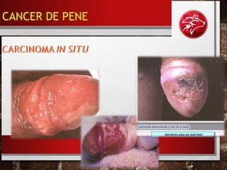• ERITROPLASIA DE QUEYRAT
CANCER DE PENE
 