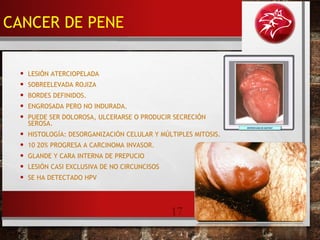 17
• LESIÓN ATERCIOPELADA
• SOBREELEVADA ROJIZA
• BORDES DEFINIDOS.
• ENGROSADA PERO NO INDURADA.
• PUEDE SER DOLOROSA, ULCERARSE O PRODUCIR SECRECIÓN
SEROSA.
• HISTOLOGÍA: DESORGANIZACIÓN CELULAR Y MÚLTIPLES MITOSIS.
• 10 20% PROGRESA A CARCINOMA INVASOR.
• GLANDE Y CARA INTERNA DE PREPUCIO
• LESIÓN CASI EXCLUSIVA DE NO CIRCUNCISOS
• SE HA DETECTADO HPV
CANCER DE PENE
 