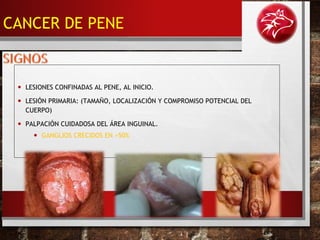 • LESIONES CONFINADAS AL PENE, AL INICIO.
• LESIÓN PRIMARIA: (TAMAÑO, LOCALIZACIÓN Y COMPROMISO POTENCIAL DEL
CUERPO)
• PALPACIÓN CUIDADOSA DEL ÁREA INGUINAL.
• GANGLIOS CRECIDOS EN >50%
CANCER DE PENE
 