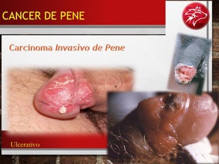 Ulcerativo
CANCER DE PENE
 