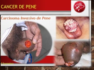 Ulcerativo
CANCER DE PENE
 