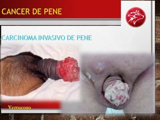Verrucoso
CANCER DE PENE
 