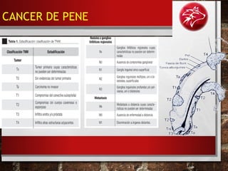 CANCER DE PENE
 